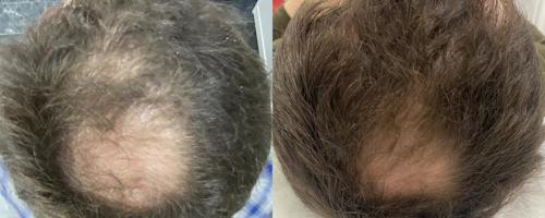 Микроигольчатый RF-лифтинг Sylfirm X в трихологии