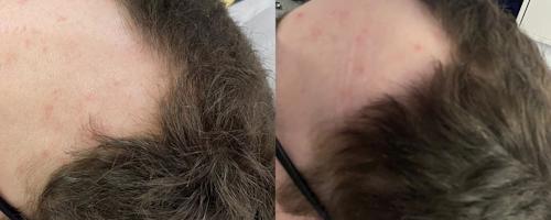 Микроигольчатый RF-лифтинг Sylfirm X в трихологии