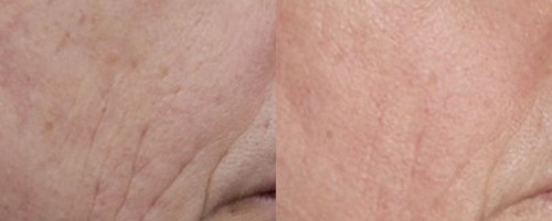 Микроигольчатый RF-лифтинг на аппарате Sylfirm X