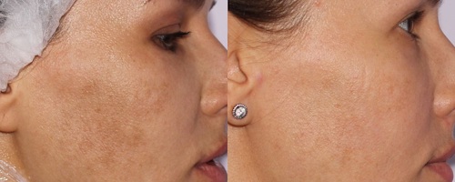 Микроигольчатый RF-лифтинг на аппарате Sylfirm X