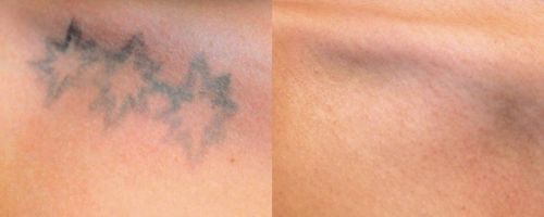 Удаление татуировок лазером Picosure