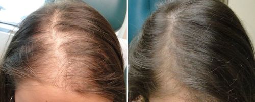 Плазмотерапия для лечения волос