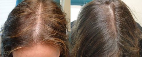 Микроигольчатый RF-лифтинг для роста волос