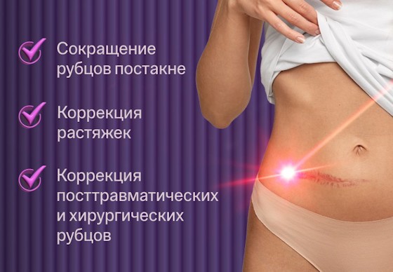 ru;Лечение рубцов ResurFX Stellar М22
