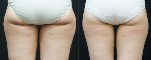Ультразвуковая липосакция Ulfit