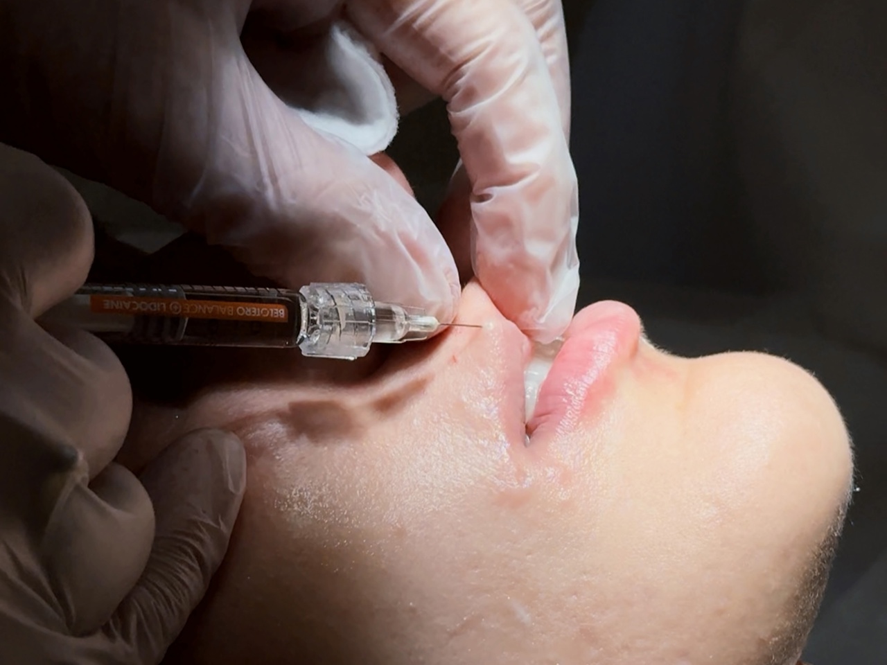 Индивидуальная постановка руки Merz Aesthetics, г. Саратов