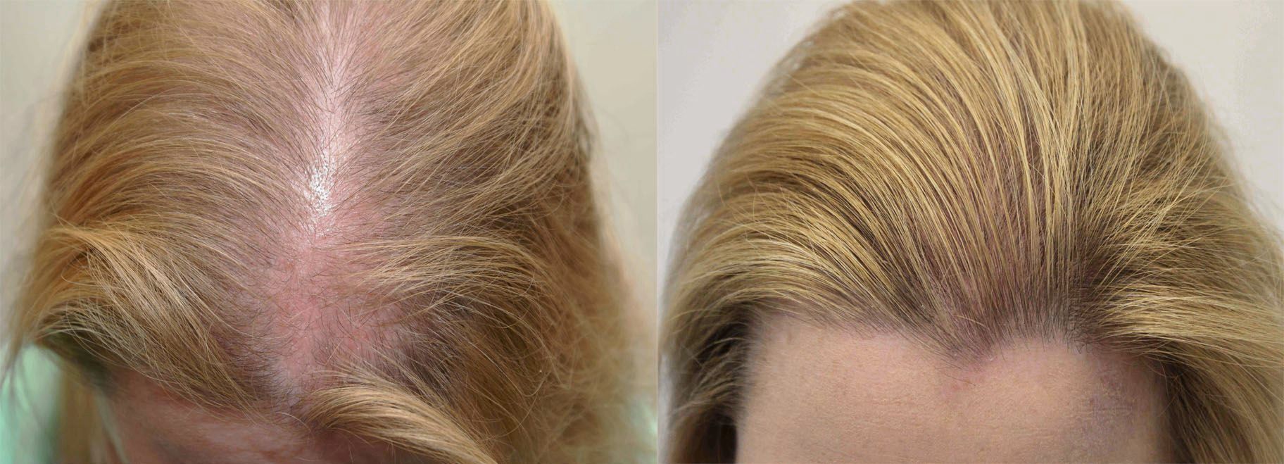 Растут корни волос. Поредение волос у женщин. Мезотерапия волос до и после.